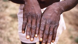 Namibia confirms first Mpox case