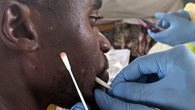Ghana confirms 34 new Mpox cases, total rises to 79