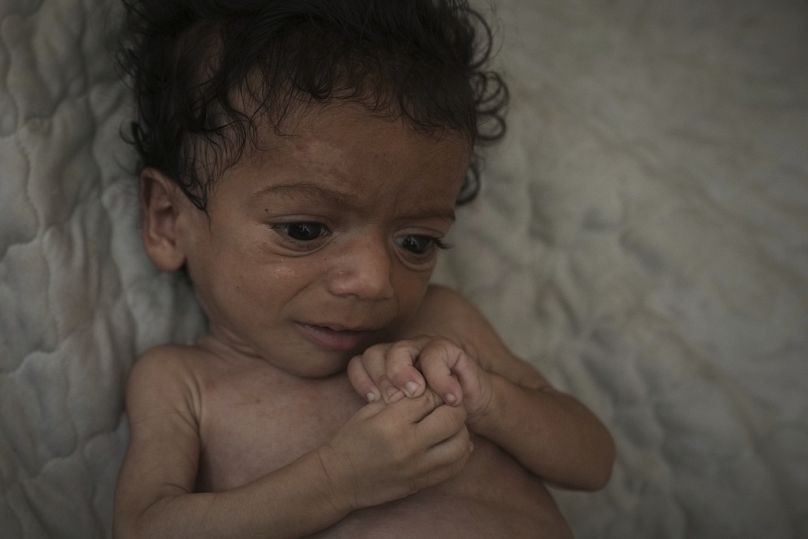 FILE - Seven-month-old Salem Awad, suffering from severe malnutrition, lies on a mattress in his family's tent in Gaza City, July 28, 2025. 
